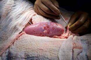 Au transplantat cu succes un rinichi de porc la un pacient uman - Premieră medicală în SUA