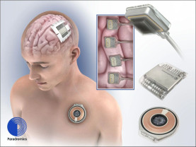 Primul pacient al companiei Neuralink căruia i s-a implantat un cip - Poate controla computerul cu gândul