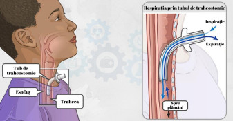 Oradea. Un copil de 12 ani grav bolnav a primit o nouă șansă la viață - Intervenţie chirurgicală dificilă